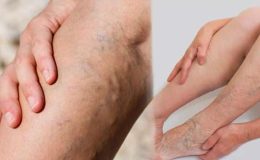 Varis nedir, neden olur? Genç yaşta ve bacakta varis belirtileri…