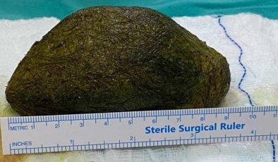 Karnım ağrıyor, diyerek doktora gitti midesinden 2 kilo saç çıktı!